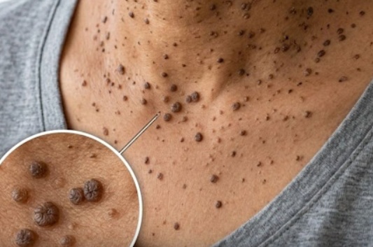 Have you also developed these skin bumps on your neck?