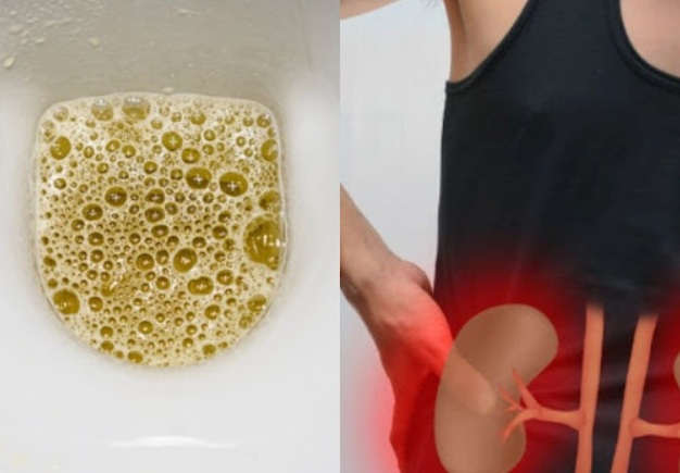 Foamy Urine: Here’s Why You Have Bubbles in Your Urine