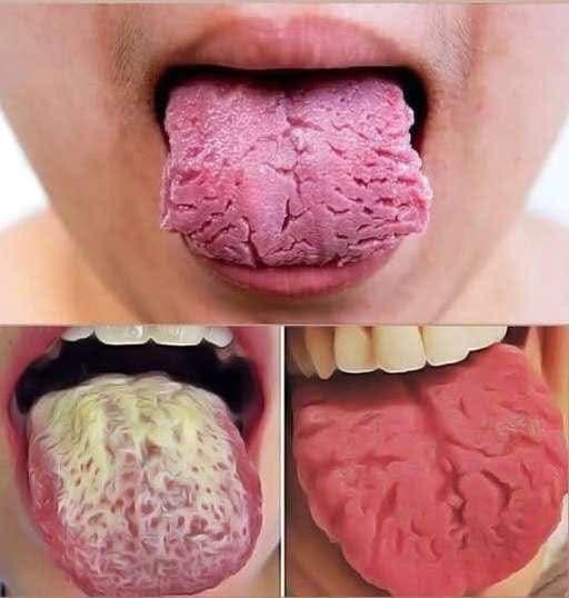 What Changes in Your Tongue May Reveal About Your Overall Well-Being