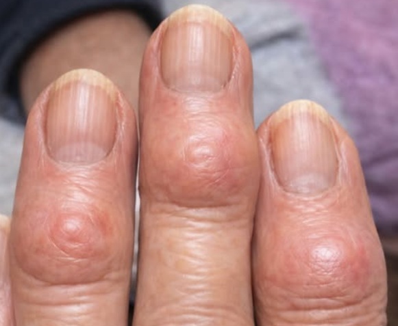 Hard bumps forming on finger joints near the nails