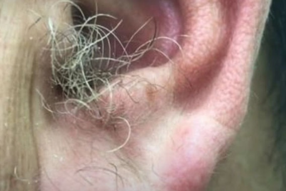 Ear Hair and Your Health: What Doctors Say About This Overlooked Body Sign