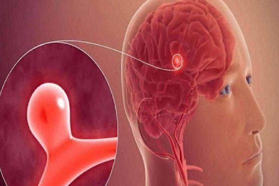 12 signs that may signal a brain aneurysm — Don’t ignore them