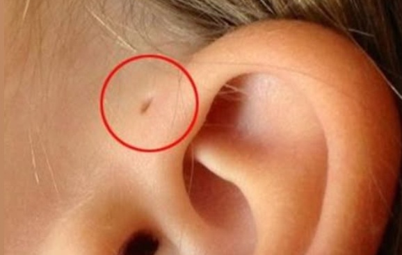 What That Tiny Hole Near the Ear Really Means: A Harmless Genetic Trait With Ancient Origins