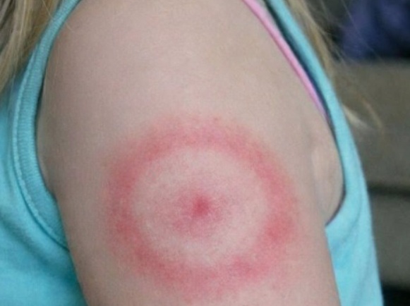 A Red Ring on Your Child’s Skin: What It Might Mean and When to Seek Advice